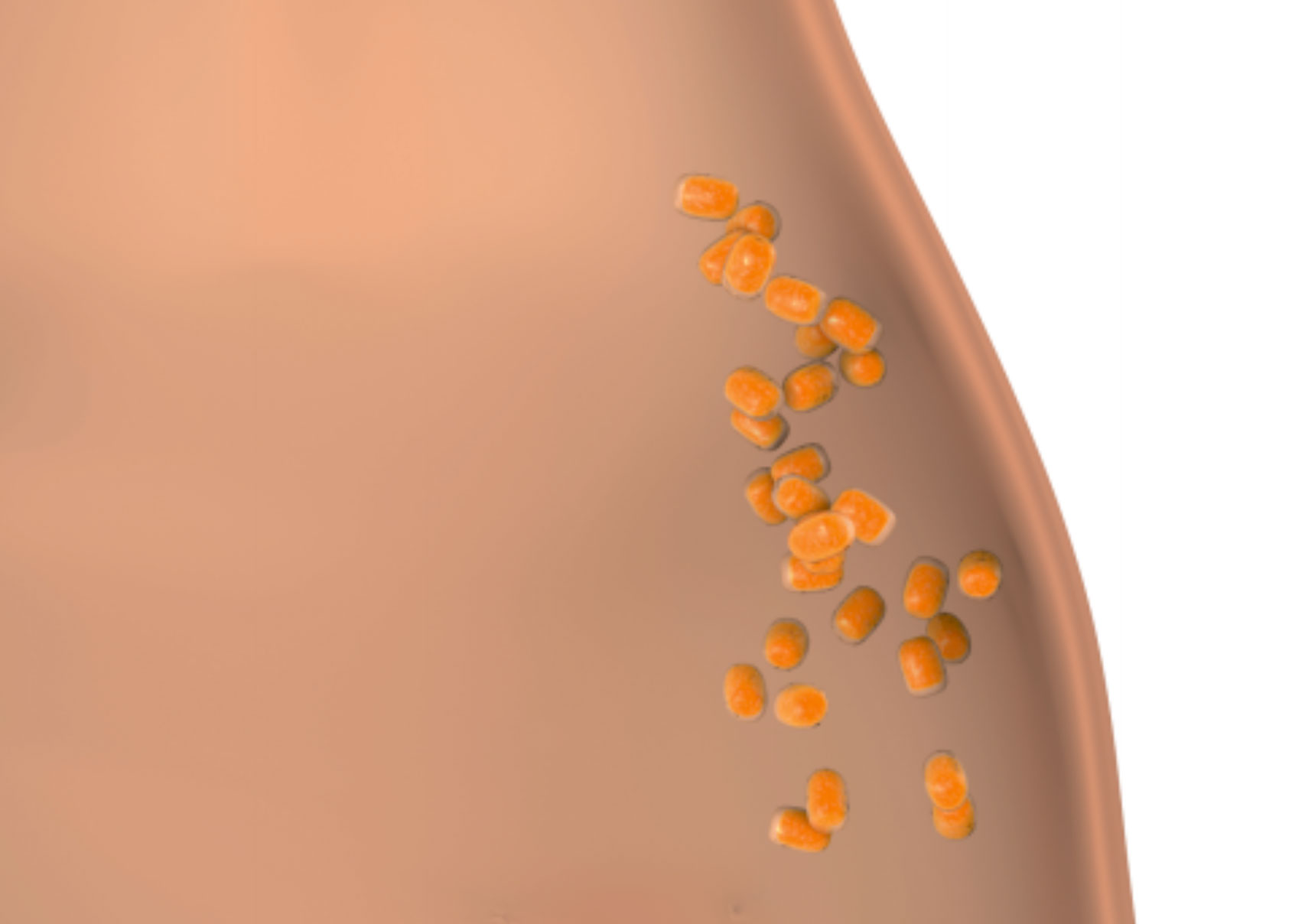 Kryolipolyse, nach der Behandlung weniger Fettzellen