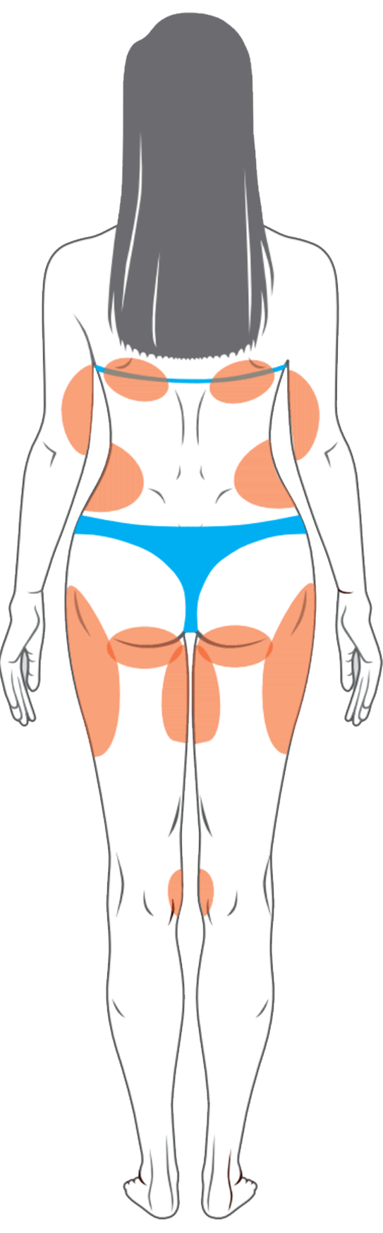 Kryolipolyse - Behandlungsbereiche hinten